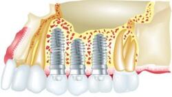 Osseointegration