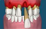Zahnausfall Ursachen