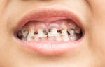 Zahnverfärbung entfernen - Die qualitativsten Zahnverfärbung entfernen analysiert