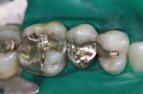 Amalgamentfernung Amalgamausleitung Beim Zahnarzt