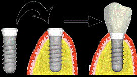 Ablauf der Implantatversorgung