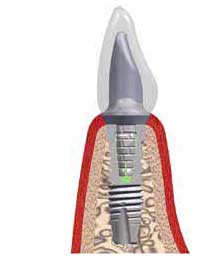 Ein Zahnersatz mit Implantat