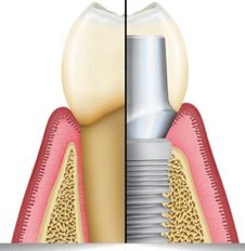 Implantat mit Zahnkrone