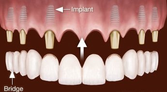 Beim Einsetzen der Implantate mit zeitnahen Belastung kommt eine moderne Planungssoftware zum Einsatz, die einen sehr präzisen Eingriff ermöglicht.