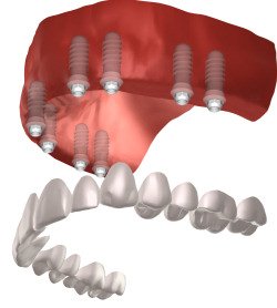 Von Schnellimplantaten spricht man, wenn der Zahnersatz bis maximal 36 Stunden nach dem Einbringen der Implantate funktionstüchtig ist.