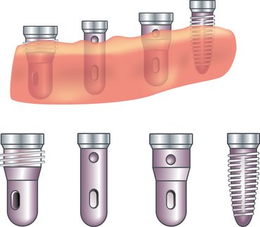 Die Implantattypen sind in verschiedenen Ausführungen und Größen zwischen 3,3mm bis 6mm Durchmesser und mit einer Länge zwischen 9 mm und 16 mm verfügbar