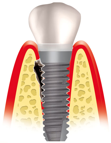 Implantatentzündung