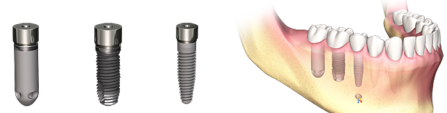 Implantatformen