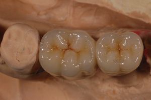 Keramik Zahnersatz ist sehr viel härter als die natürliche Zahnsubstanz. Aus diesem Grund kann es hier zu Schäden an den gegenüberliegenden, natürlichen Zähnen kommen.