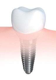 Implantatkrone bei gesundem Zahnfleisch