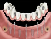 Selbst bei schwierigen Knochensituationen, wo Knochenverlust stattgefunden hat, können Schmal Implantate eingesetzt werden. Sie finden dabei auch in sehr engen Zahnlücken Platz.