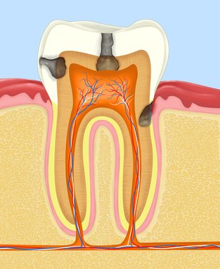 Faule Zahne Entstehung Und Behandlung Fauler Zahne