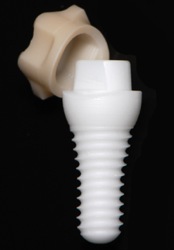 Meist bestehen Implantate aus Keramik aus einer Mischung aus Zirconium, Silicium und Yttriumoxid.