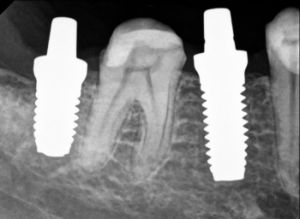 Da diese Iimplantate noch relativ neu sind in der Zahnchirurgie gibt es keine Langzeitstudiuen zu Verträglichkeit und Haltbarkeit.