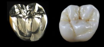 Ist die Zahnerosion fortgeschritten können Kronen eingesetzt werden, in den meisten Fällen kann die rechtzeitige Prophylaxe das aber verhindern.