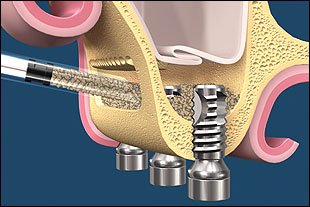 Damit Implantate im Kiefer halten können, muss im Vorfeld häufig ein Sinuslift und Augmentation stattfinden.
