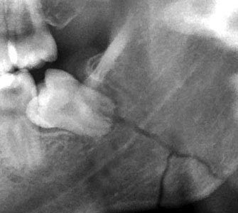 Ein Bruch des Kiefers kann ausschließlich durch eine Röntgenaufnahme genau diagnostiziert werden.