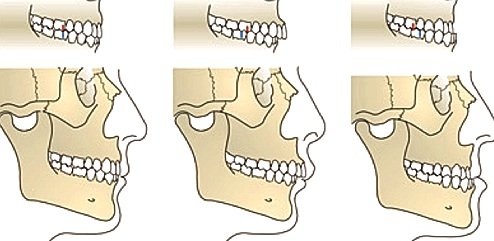 Kieferfehlstellungen im Vergleich zum Regelgebiss