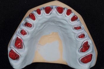 Kiefermodell-Zahnabdruck