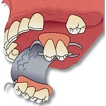 Als Provisorium wird die Klammerprothese herausnehmbar am Gaumen und an den Zähnen mit Metallklammern befestigt.