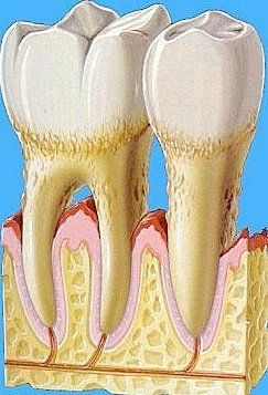 Zahnfleischschwund