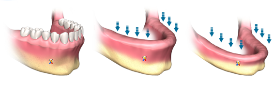 Knochenschwund im Kiefer ist häufig, besonders nach Zahnverlust.