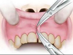 Gerissen frenulum Frenulum breve