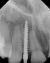 Auch einzelne Zähne werden mit Kleinstimplantaten versorgt - besonders bei Zahnlücken oder Fehlstellungen, wird diese Art Implantat genutzt!