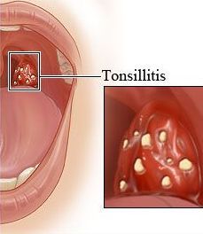 Mandelentzündung - Tonsillitis verursacht Schmerzem im Hals