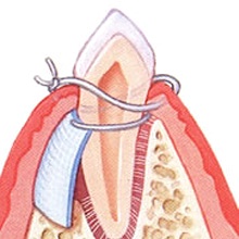 Membran bei Knochenabbau am Zahn