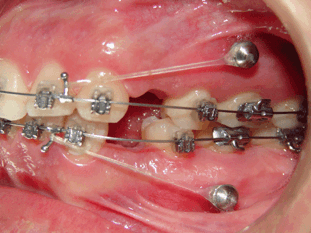 In der Kieferorthopädie helfen Kleinstimplantate die Zähne langfristig zu begradigen.