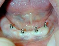 Kleinstimplantate können aber auch vor den späteren regulären Implantaten eingesetzt werden, um vorübergehend die Funktionalität der Zähne wieder herzustellen.
