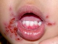 Mundfaule Stomatitis Bei Babys Kindern