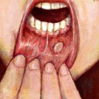 Ein erstes Anzeichen für die schleichende Krebserkrankung im Mund sind Veränderungen an der Schleimhaut wie s.g. Präkanzerosen.