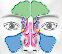 Durch den direkten Anschluss kann eine Entzündung der Nasenschleimhaut auch auf die Nebenhöhlen (Nasennebenhöhlenentzündung) übergehen, also bei jedem durch Viren oder Bakterien ausgelösten Schnupfen.