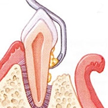 Offene Parodontaloperation