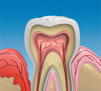Als häufigste Ursache für Zahnverlust gilt die Paradontose. Wird sie jedoch rechtzeitig behandelt, können die Zähne häufig erhalten bleiben.