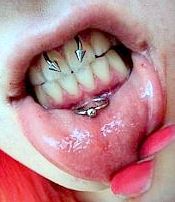 Die harten Materialien der Piercings im Mundbereich können den Zahnschmelz und die Zähne auf Dauer schädigen.