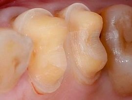 Besonders bei abgeschliffenen Zähnen vor dem Einsetzen von Zahnkronen, um das empfindliche Dentin zu schützen.