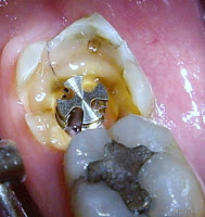 Unterschied zwischen Stiftzahn & Implantat