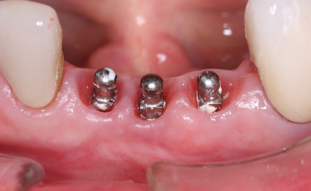 Die Implanttfreilegung ist der Schritt zwischen dem Einsetzen der Implantate und der prothetischen Versorgung mit Zahnersatz.