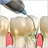 Bei sehr tiefen Zahnfleisch- bzw. Knochentaschen kann eine chrirugische Öffnung vorgenommen werden, bei der auch der Knochen durch Ersatzmaterialien wieder aufgebaut wird.