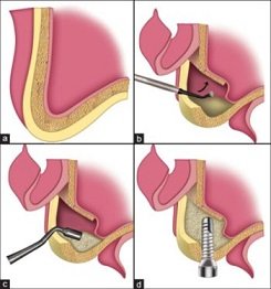 Ein offener Knochenaufbau kommt zum Einsatz, wenn ein größerer Implantataufbau geplant ist.