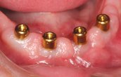Eine einfache Methode mit Zahnimplantaten wurde von Dr. May entwickelt, indem in einer Sitzung die vorhandene Totalprothese mittels konischer, präfabrizierter Abutments
