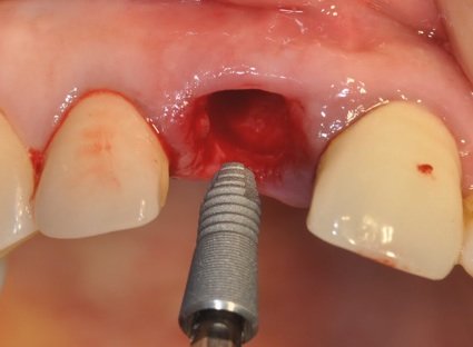 Zahnimplantat im Zahnfach