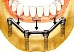 Mit einer steggetragenen Prothese haben Sie die beste Zahnersatzlösung im zahnlosen Ober- oder Unterkiefer.