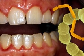 Zahnfleischbluten wegen Stomatitis
