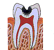 Eine häufige Ursache für Zahnschmerzen ist eine tiefe Karies