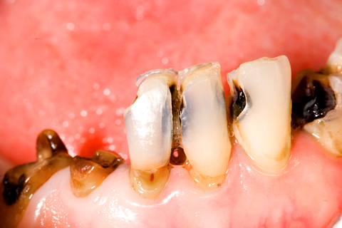 Tiefe Karies als Ursache für chronische Zahnwurzelentzündung