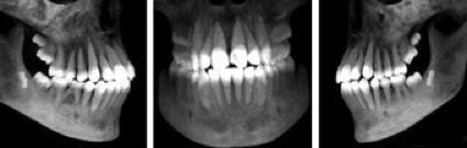 Beim Zahnarzt werden Tomographien meist aus der Frontalsicht oder von der Seite vorgenommen, um einen genauen Überblick zu erhalten.